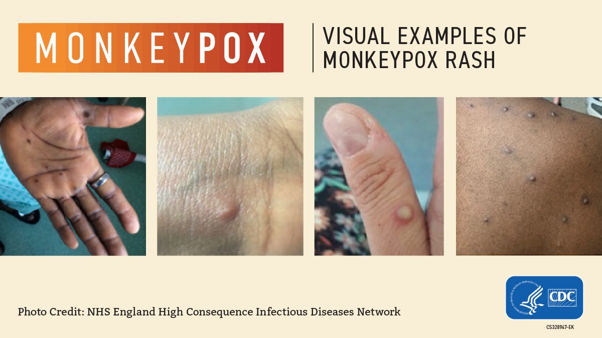 Monkeypox Delaware County, Pennsylvania